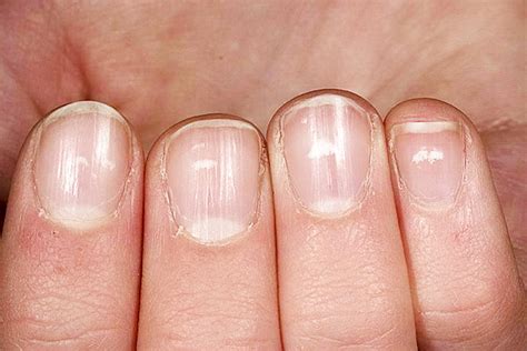 Белые пятна на ногтях пальцев рук причина у женщин