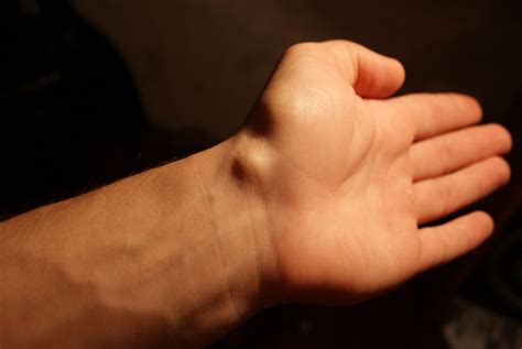 Боль в запястье левой руки причины лечение