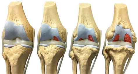 Гонартроз коленного сустава лечение медикаментозное