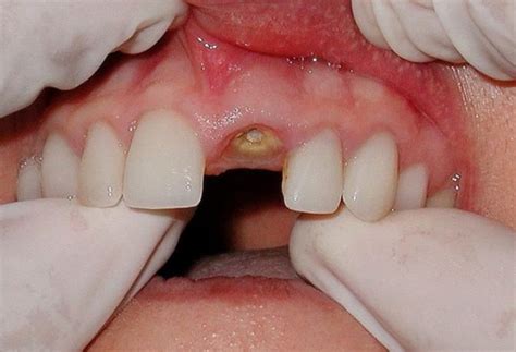 Заживление лунки после удаления зуба