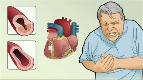 Инфаркт миокарда симптомы у женщин первые признаки и лечение