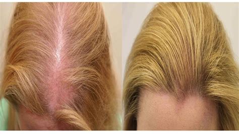 Как избавиться от выпадения волос