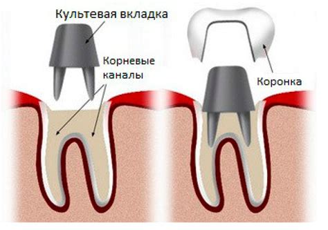 Как ставят коронку на зуб