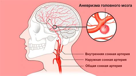Симптомы аневризмы головного мозга у женщин