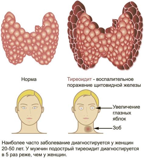 Симптомы болезни щитовидной железы у женщин