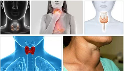 Симптомы болезни щитовидной железы у женщин