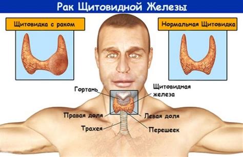 Тиреоидит щитовидной железы что