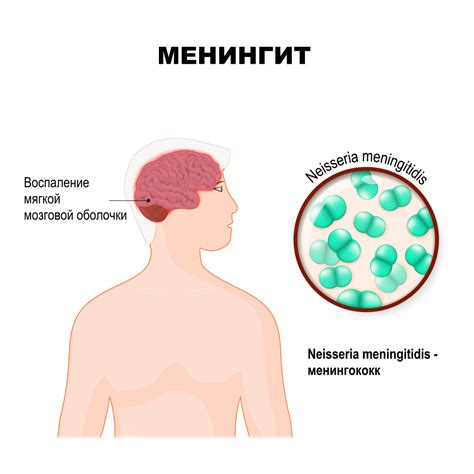 Что вызывает менингит