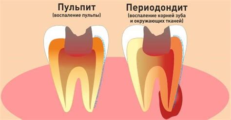 Что такое периодонтит зуба