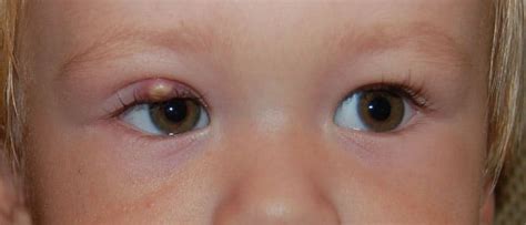 Ячмень на глазу лечение у ребенка чем лечить