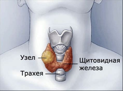 Гиперплазия щитовидной железы