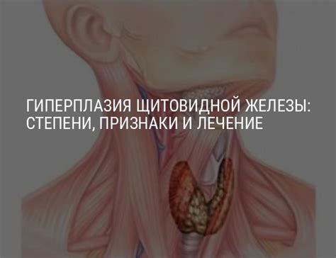 Гиперплазия щитовидной железы