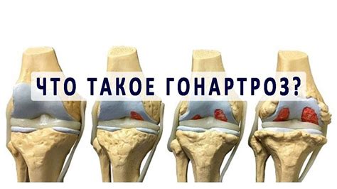 Гонартроз коленного сустава лечение медикаментозное
