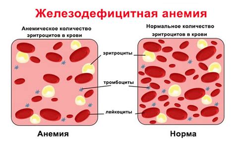 Железодефицитная анемия мкб
