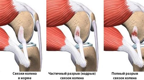 Как лечить растяжение связок коленного сустава