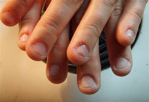 Почему человек грызет ногти