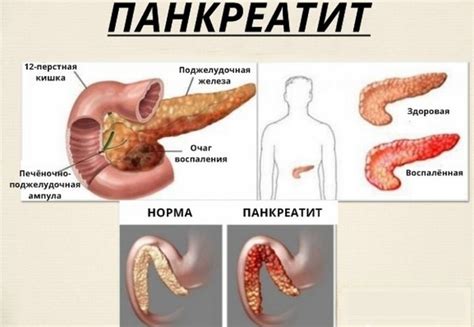 Симптомы панкреатита поджелудочной железы у женщины