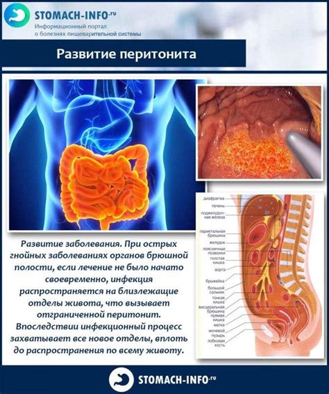 Симптомы перитонита