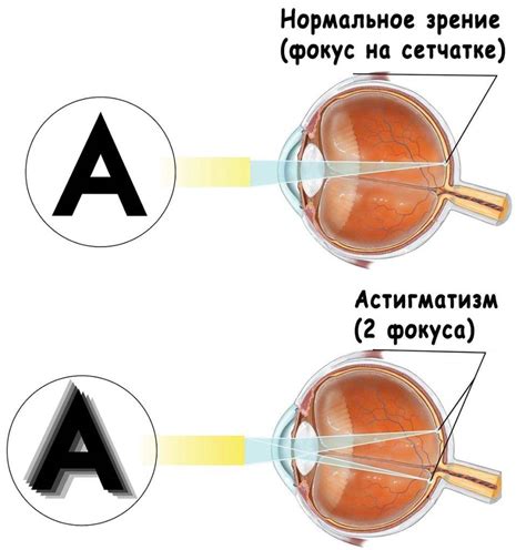 Сложный миопический астигматизм обоих глаз
