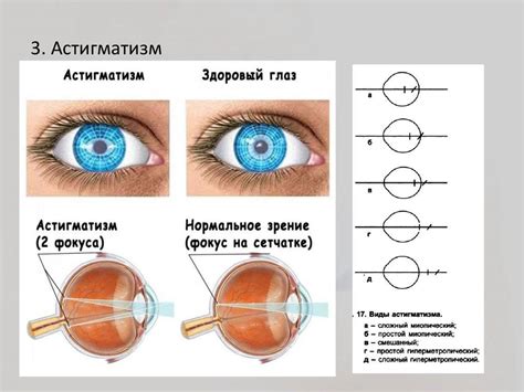 Сложный миопический астигматизм обоих глаз