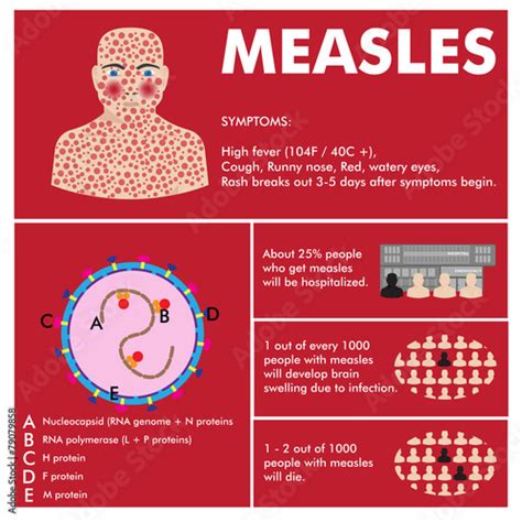 Measles